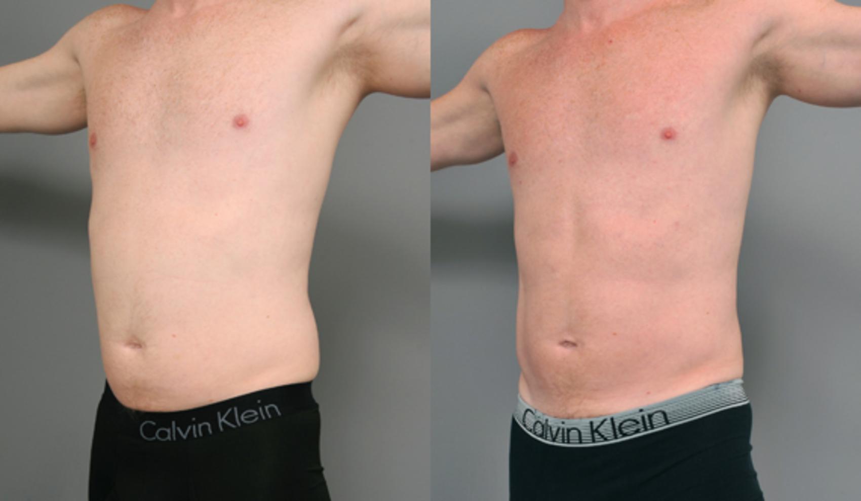 Before & After Liposuction Case 208 View #1 View in New York, NY