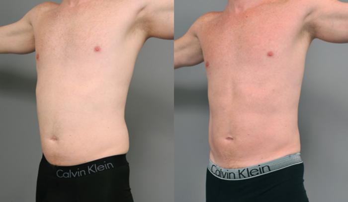 Before & After Liposuction for Men Case 208 View #1 View in New York, NY