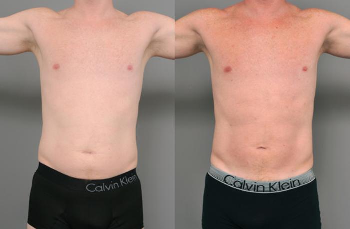 Before & After Liposuction for Men Case 208 View #2 View in New York, NY
