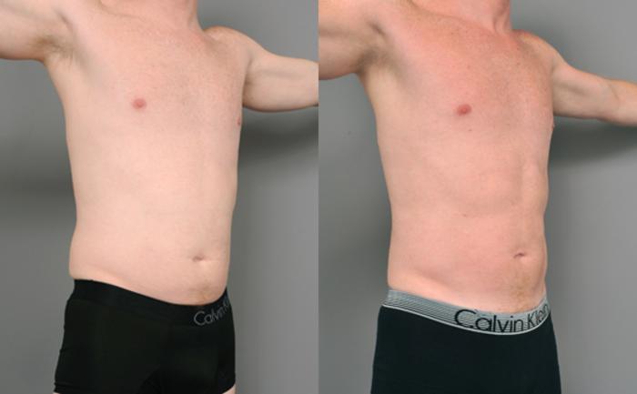 Before & After Liposuction for Men Case 208 View #3 View in New York, NY