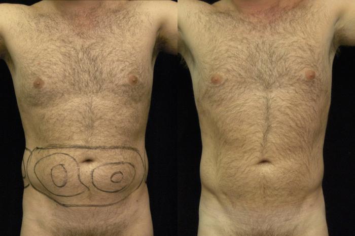 Before & After Liposuction for Men Case 33 View #1 View in New York, NY