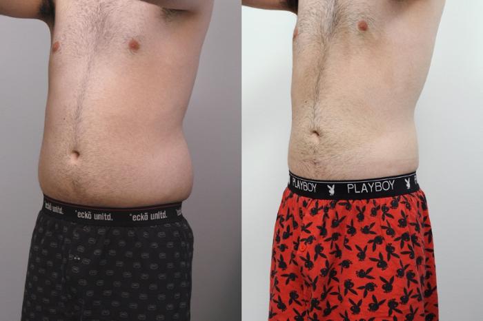 Before & After Liposuction Case 34 View #1 View in New York, NY