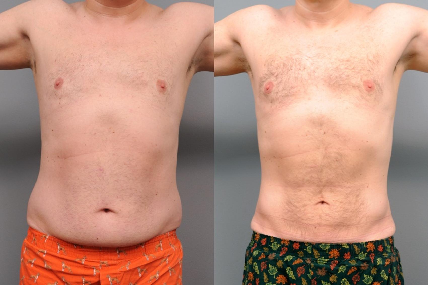 Before & After Liposuction Case 47 View #1 View in New York, NY