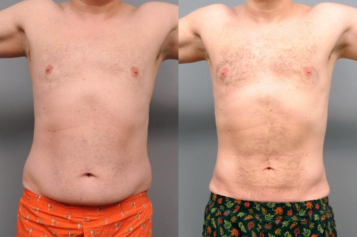 Before & After Liposuction for Men Case 47 View #1 View in New York, NY