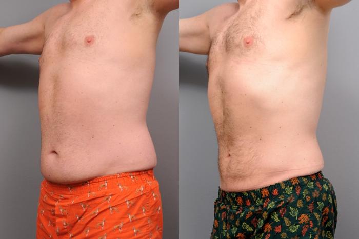 Before & After Liposuction for Men Case 47 View #2 View in New York, NY
