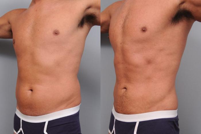 Before & After Liposuction Case 5 View #1 View in New York, NY