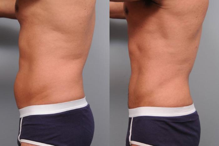 Before & After Liposuction for Men Case 5 View #2 View in New York, NY