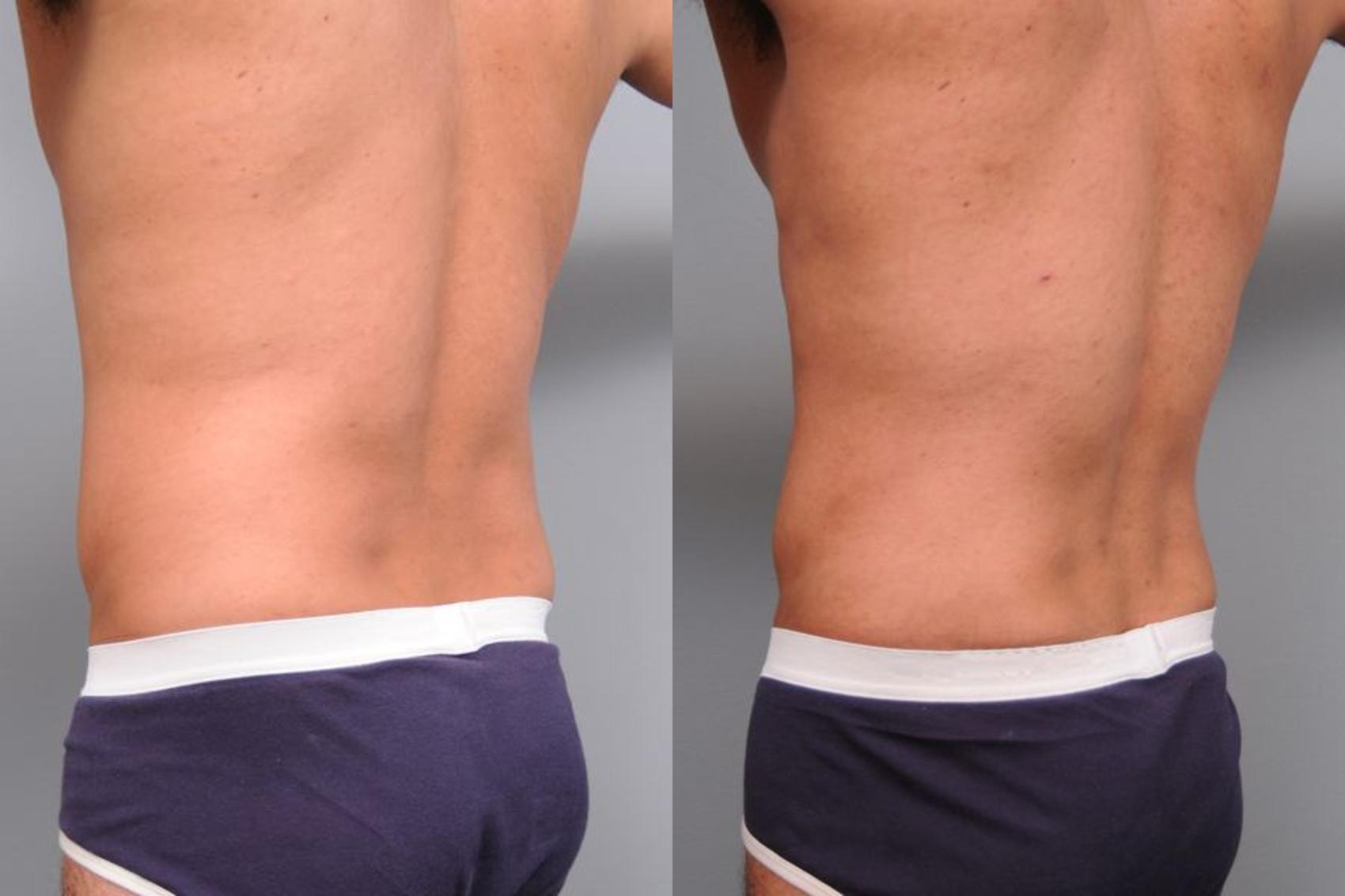 Before & After Liposuction for Men Case 5 View #3 View in New York, NY