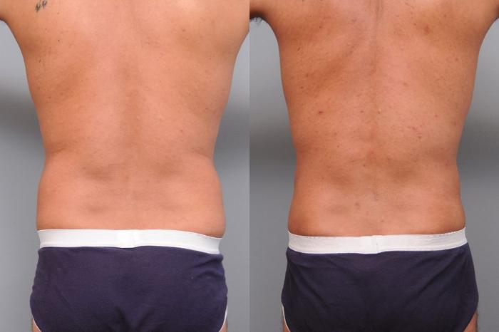 Before & After Liposuction for Men Case 5 View #4 View in New York, NY