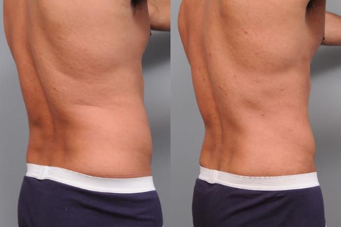 Before & After Liposuction for Men Case 5 View #5 View in New York, NY