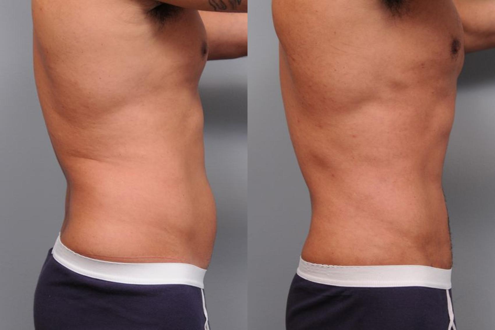 Before & After Liposuction for Men Case 5 View #6 View in New York, NY