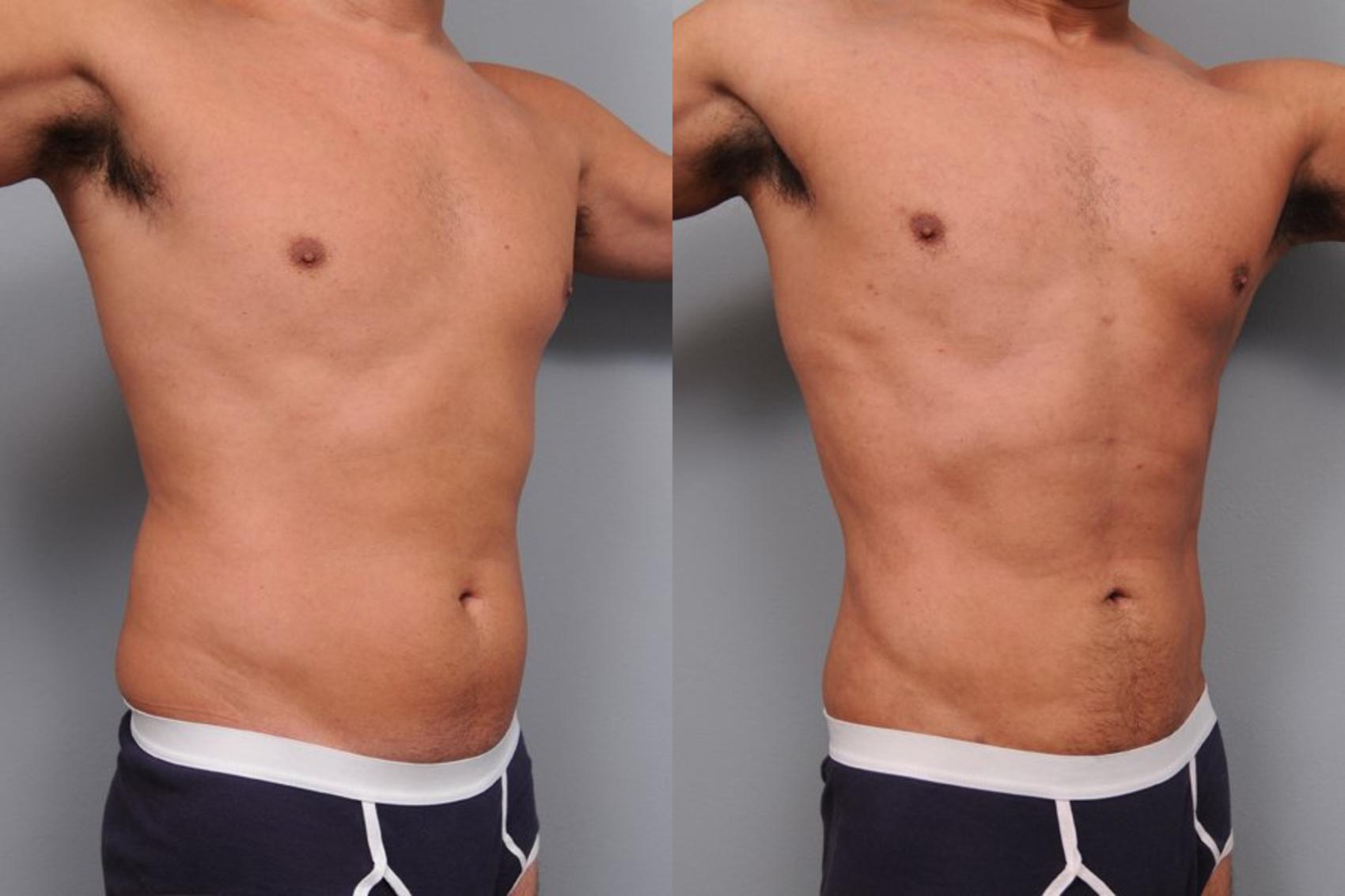 Before & After Liposuction for Men Case 5 View #7 View in New York, NY