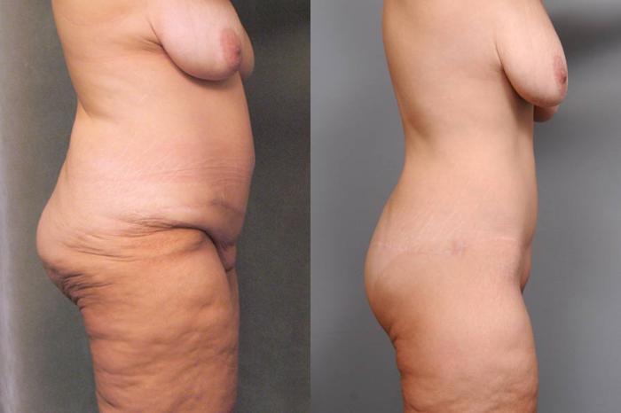 Before & After Lower Body Lift Case 126 View #2 View in New York, NY