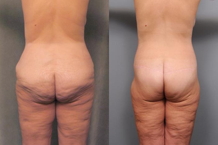 Before & After Lower Body Lift Case 126 View #3 View in New York, NY