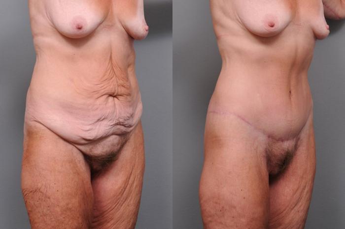 Before & After Lower Body Lift Case 128 View #2 View in New York, NY