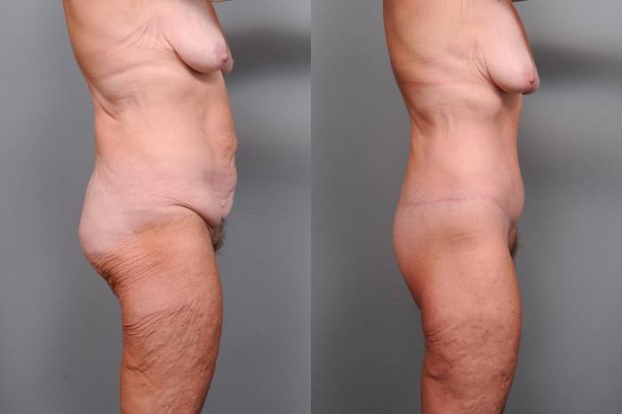 Before & After Lower Body Lift Case 128 View #3 View in New York, NY