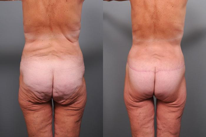 Before & After Lower Body Lift Case 128 View #5 View in New York, NY