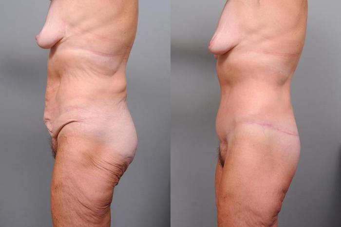 Before & After Lower Body Lift Case 128 View #6 View in New York, NY