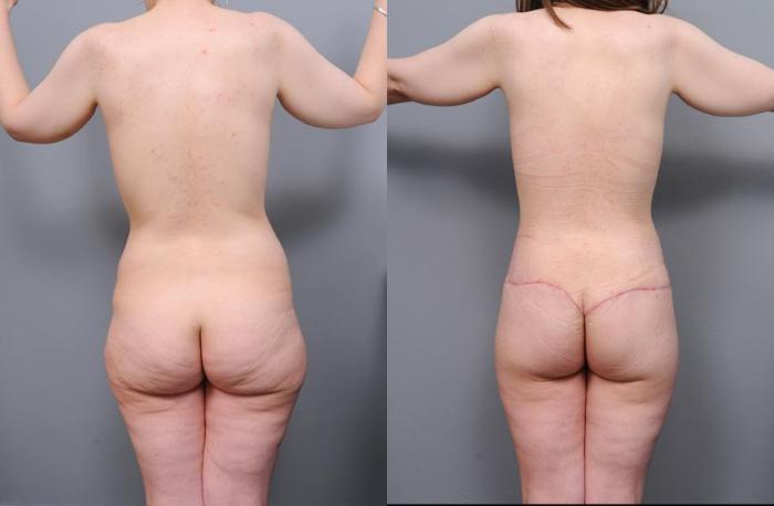 Before & After Lower Body Lift Case 131 View #3 View in New York, NY