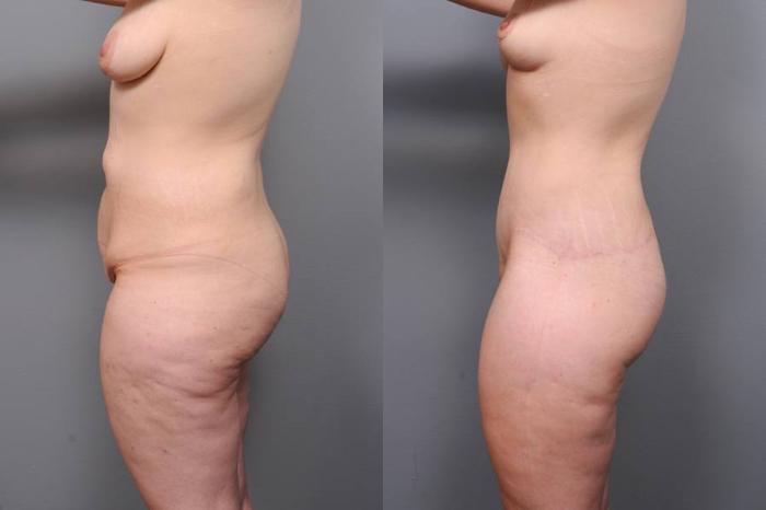 Before & After Lower Body Lift Case 131 View #4 View in New York, NY