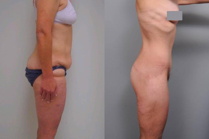 Before & After Lower Body Lift Case 133 View #3 View in New York, NY