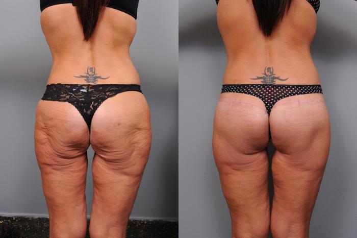 Before & After Lower Body Lift Case 134 View #3 View in New York, NY