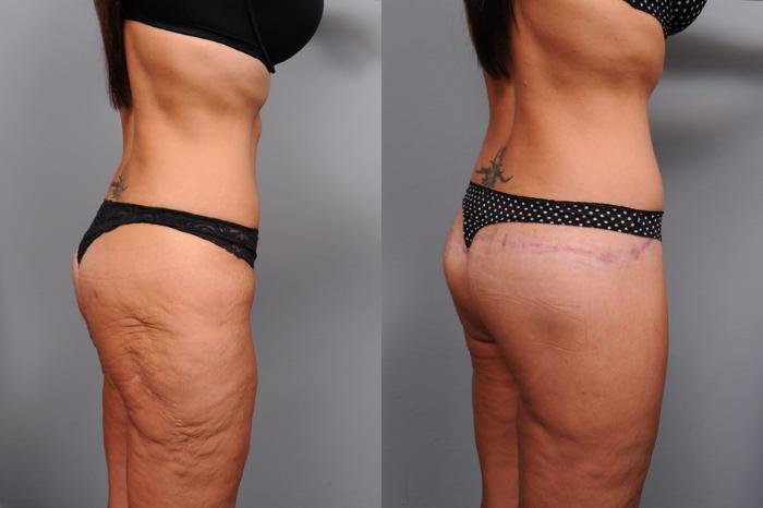 Before & After Lower Body Lift Case 134 View #4 View in New York, NY