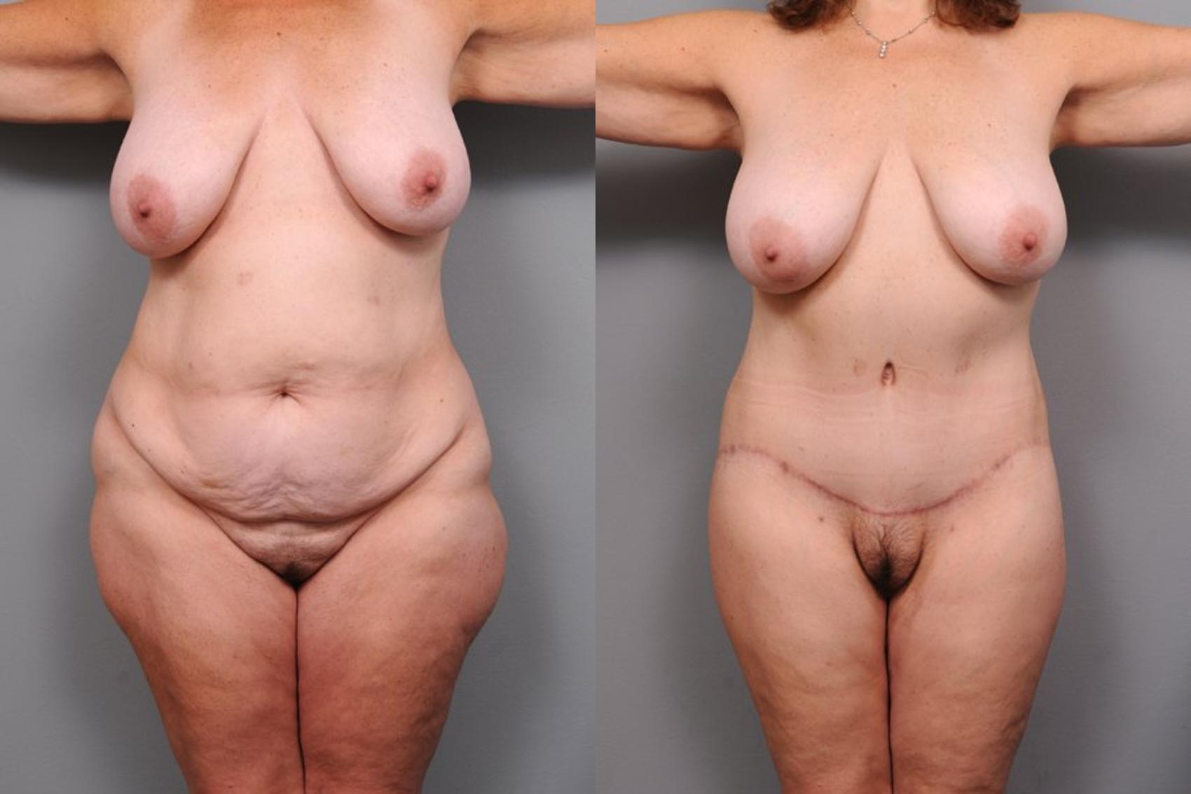Before & After Lower Body Lift Case 135 View #1 View in New York, NY