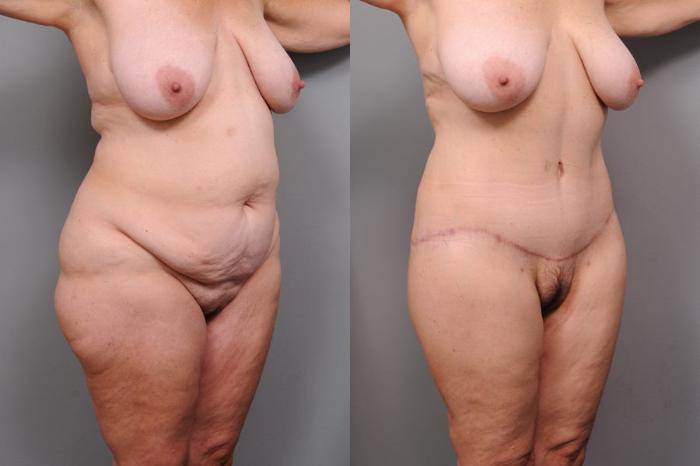 Before & After Lower Body Lift Case 135 View #2 View in New York, NY