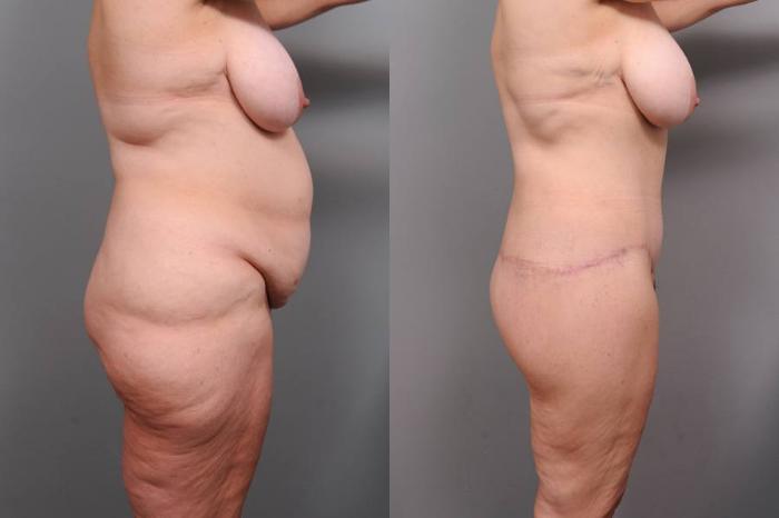Before & After Lower Body Lift Case 135 View #3 View in New York, NY