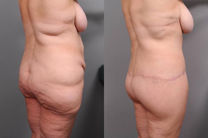 Before & After Lower Body Lift Case 135 View #4 View in New York, NY
