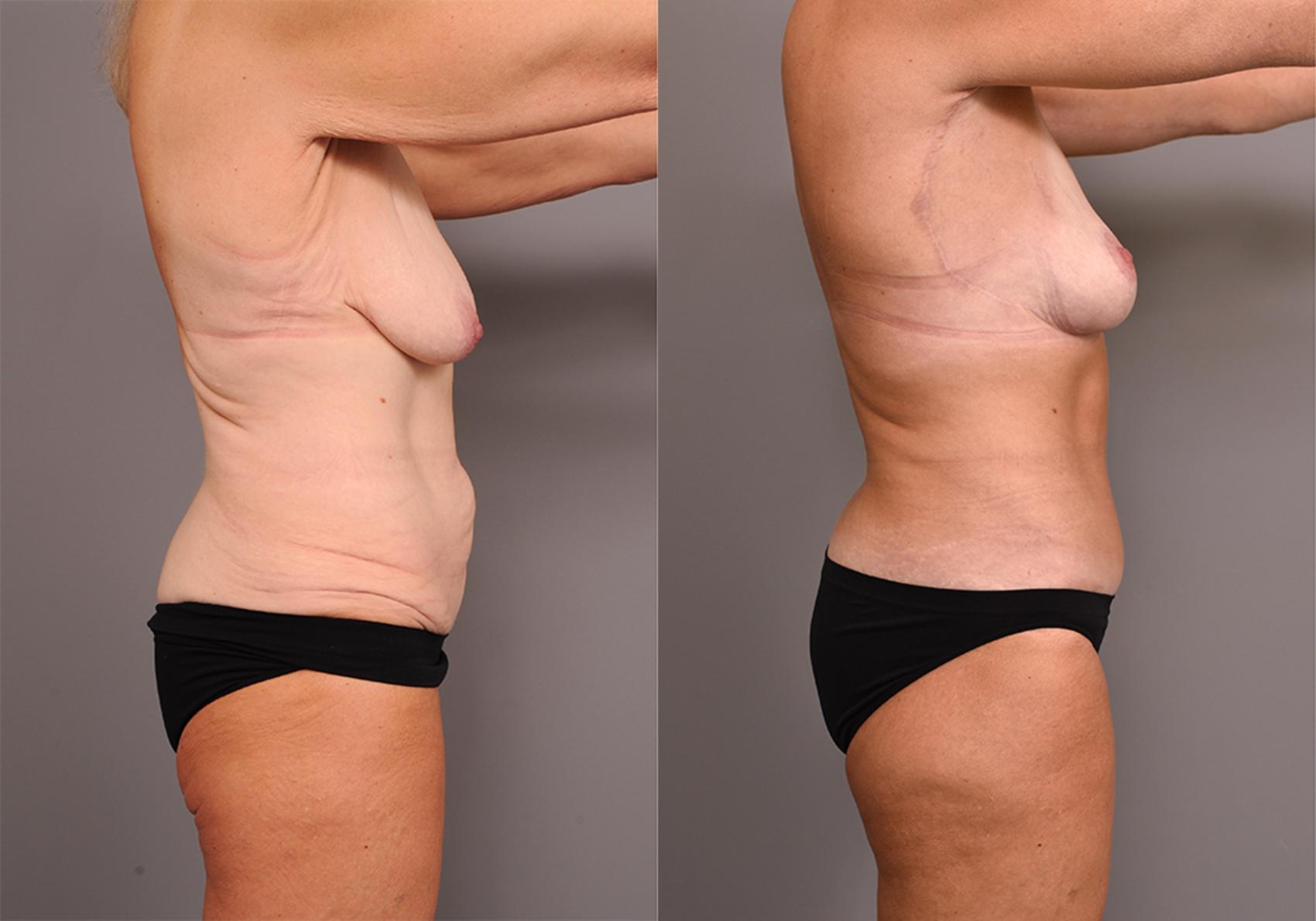 Before & After Lower Body Lift Case 247 View #3 View in New York, NY