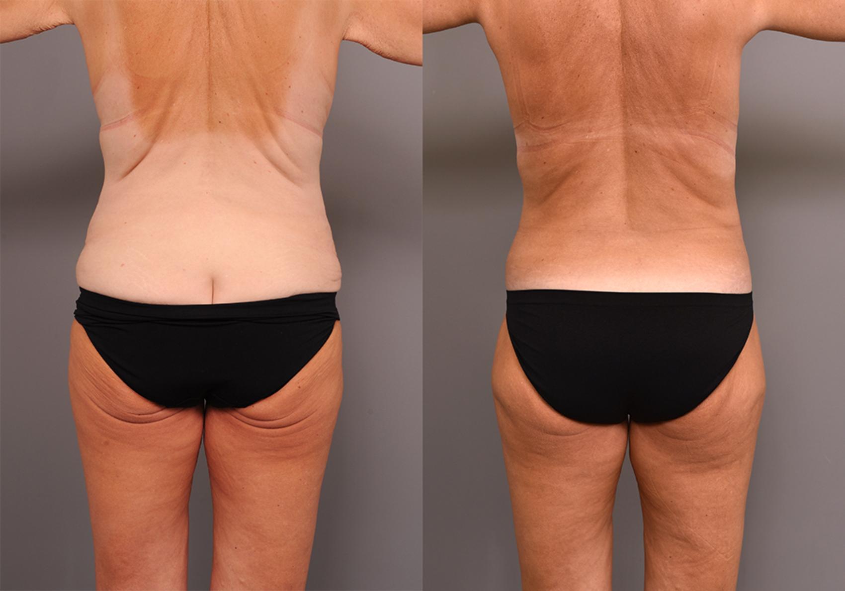 Before & After Lower Body Lift Case 247 View #4 View in New York, NY