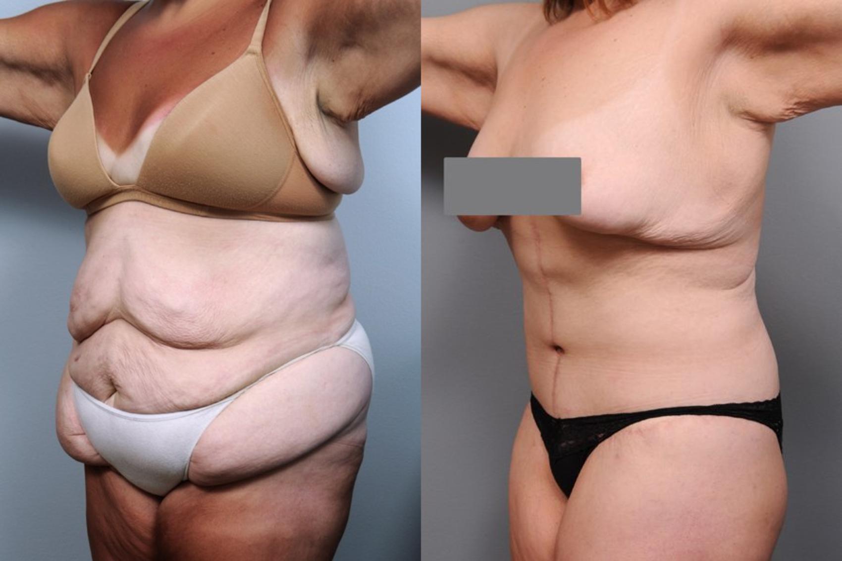 Before & After Lower Body Lift Case 89 View #2 View in New York, NY