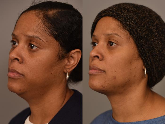 Before & After Mini Neck Lift (Single Incision) Case 258 Right Oblique View in New York, NY