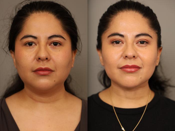 Before & After Mini Neck Lift (Single Incision) Case 309 Front View in New York, NY