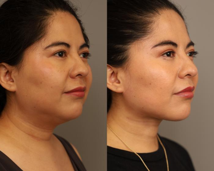 Before & After Mini Neck Lift (Single Incision) Case 309 Left Side View in New York, NY