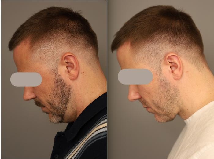 Before and After Male Neck Lift in New York City