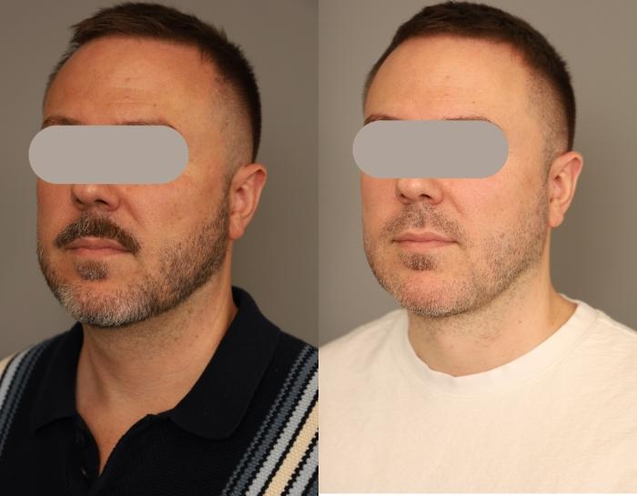 Male Neck Lift Before and After Photos