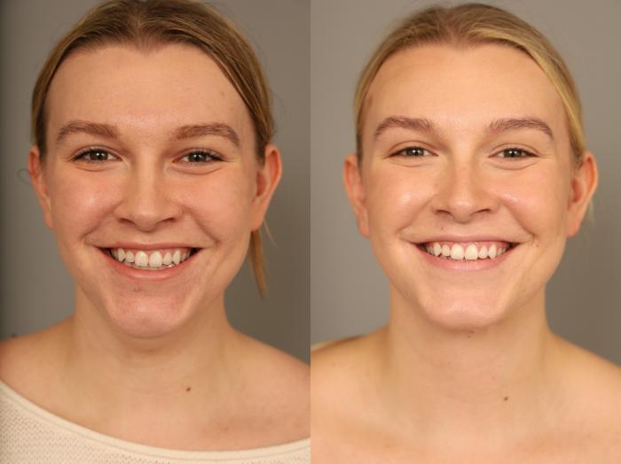 Before & After Mini Neck Lift (Single Incision) Case 315 Front View in New York, NY
