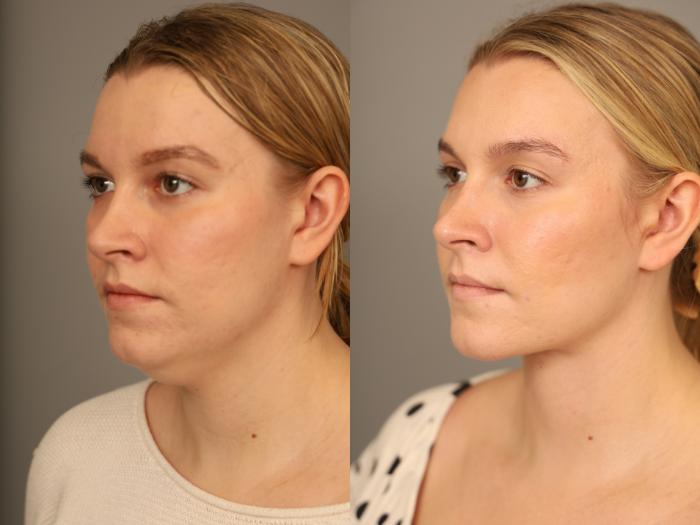 Before & After Mini Neck Lift (Single Incision) Case 315 Left Oblique View in New York, NY