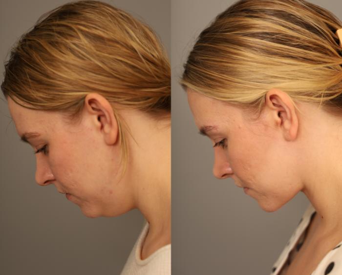 Profile on downward gaze greatly improved after a deep mini neck lift