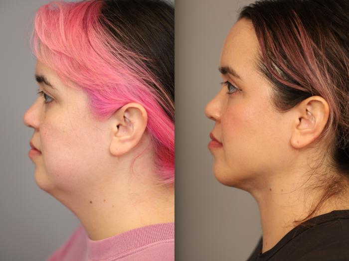 Best Neck Lift in NYC