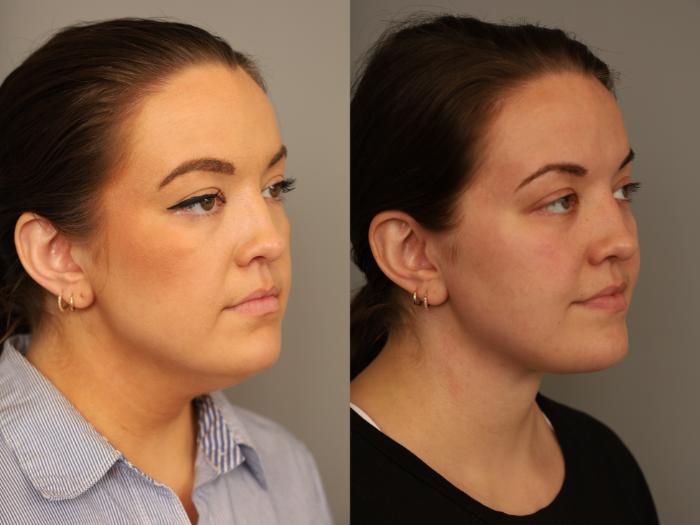 Before & After Mini Neck Lift (Single Incision) Case 323 Left Oblique View in New York, NY