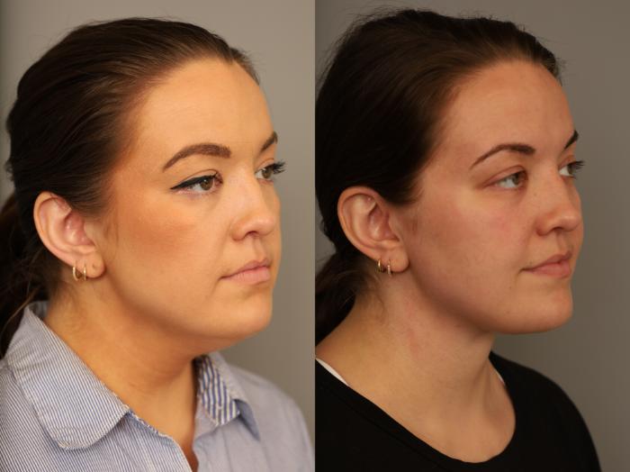 Before & After Mini Neck Lift (Single Incision) Case 323 Right Oblique View in New York, NY