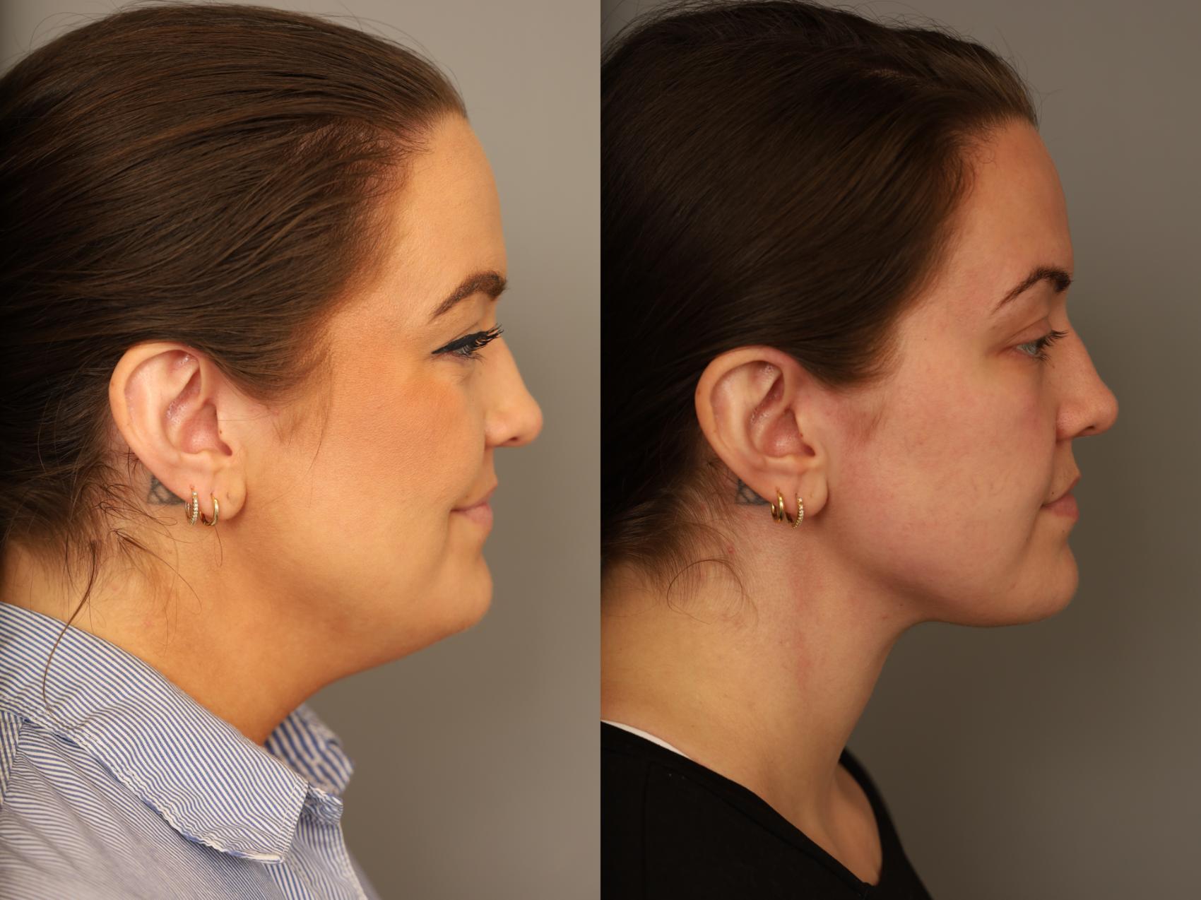 Before and After images of a 28 yo NYC woman with a mini deep neck lift