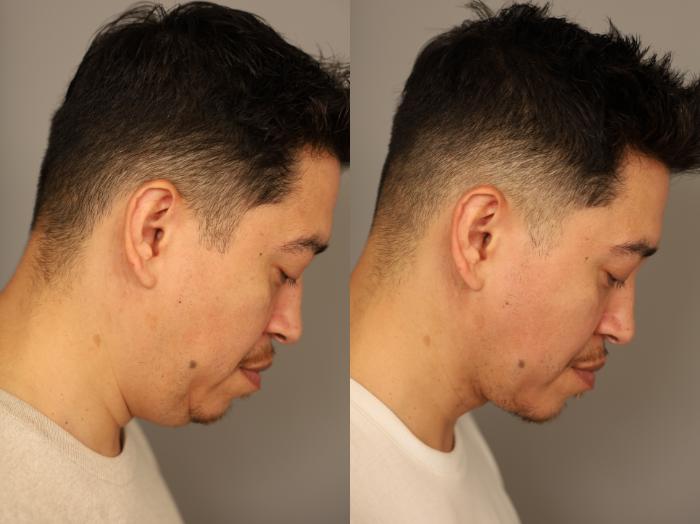 Before and after mini neck lift male 