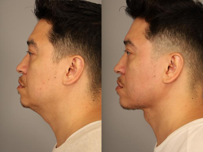 Before & After Mini Neck Lift (Single Incision) Case 329 Left View in New York, NY