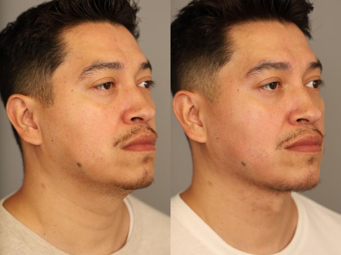 Before & After Mini Neck Lift (Single Incision) Case 329 Right Oblique View in New York, NY