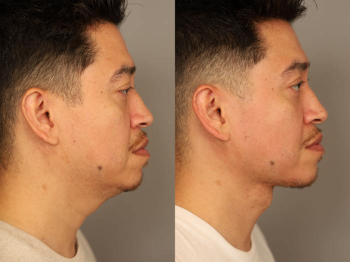 Before and after mini neck lift male 